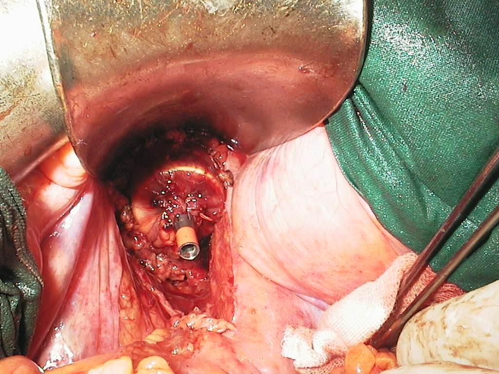 Cancerul rectal (recto-siqmoidian)